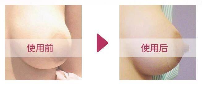 乳房重建最新技术与步骤指南