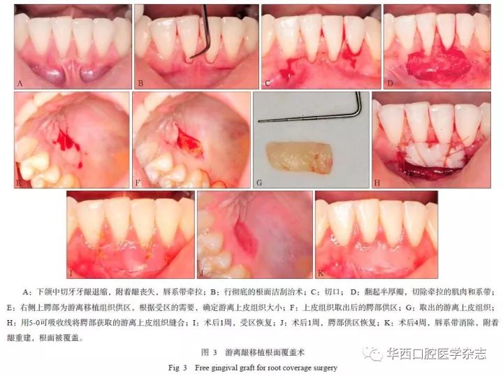 日本牙龈再生技术的最新进展与研究动态