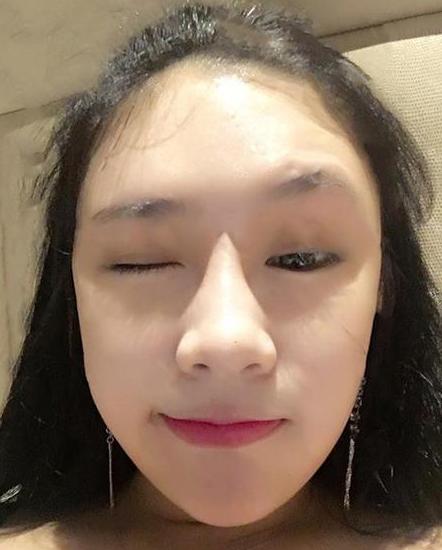 双眼皮手术的新趋势，奇妙旅程开启